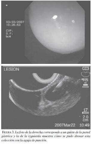 Quiste de la Pared Gástrica Quiste de la Pared Gástrica