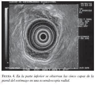 Pared del Estómago en una Ecoendoscopia Radial