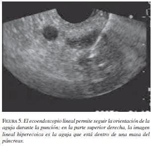 El Ecoendoscopio Lineal