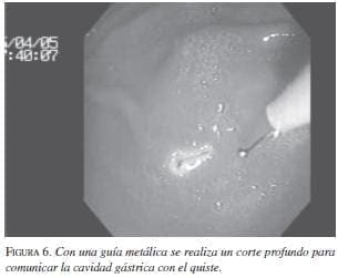 Con una Guía Metálica se realiza un Corte Profundo para comunicar la cavidad Gátrica con el Quiste Con una Guía Metálica se realiza un Corte Profundo para comunicar la cavidad Gátrica con el Quiste