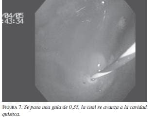 Se pasa una Guía de 0,35, la cual Avanza a la Cavidad Quística Se pasa una Guía de 0,35, la cual Avanza a la Cavidad Quística