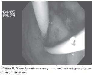 Sobre la Guía se Colocan uno o dos Stents de doble Cola Sobre la Guía se Colocan uno o dos Stents de doble Cola