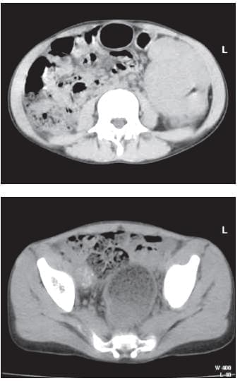 TC de Abdomen donde de Observa el Tumor de Colon Izquierdo y la Adenopatía Calcificada