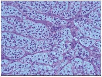 Componente Adenomatoso del Tumor Componente Adenomatoso del Tumor
