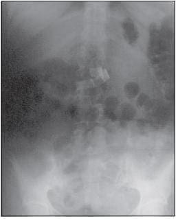 Radiografía Simple de Abdomen   Radiografía Simple de Abdomen