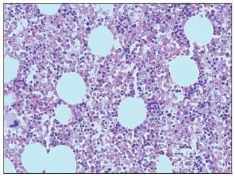 Interfase entre el Componente Adenomatoso y el Mielolipomatoso Interfase entre el Componente Adenomatoso y el Mielolipomatoso