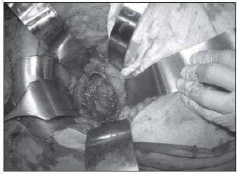 Úlcera Gigante del Antro Causada por Migración Transmural del “Compresoma” Úlcera Gigante del Antro Causada por Migración Transmural del “Compresoma”