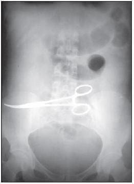 Cuerpo Extraño Olvidado en la Cavidad Abdominal (pinza de Kelly).  Cuerpo Extraño Olvidado en la Cavidad Abdominal (pinza de Kelly).