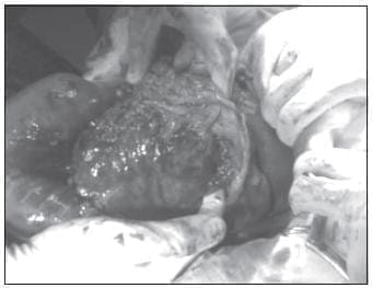 Tumor en Vías de Resección Tumor en Vías de Resección