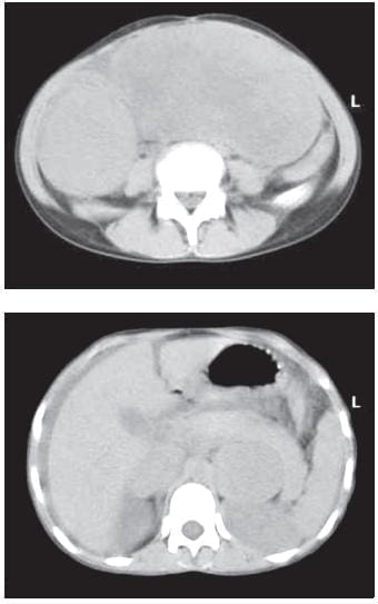 TC de Abdomen Donde se Observan los Tumores de Glándula Suprarrenal Izquierda y Ovarios TC de Abdomen Donde se Observan los Tumores de Glándula Suprarrenal Izquierda y Ovarios