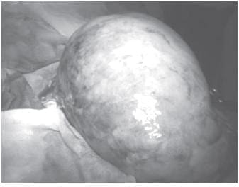 Tumor de Ovario Tumor de Ovario