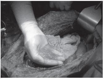 Ascitis mucinosa Distribuida de forma Aleatoria en la cavidad Peritoneal Ascitis mucinosa Distribuida de forma Aleatoria en la cavidad Peritoneal
