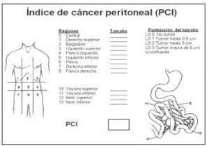 Índice de Cáncer Peritoneal Índice de Cáncer Peritoneal