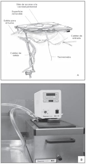 A. Sistema de Sugarbaker y Catéteres B. Recipiente utilizado para calentar la Quimioterapia A. Sistema de Sugarbaker y Catéteres B. Recipiente utilizado para calentar la Quimioterapia