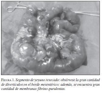 Segmento de Yeyuno Resecado