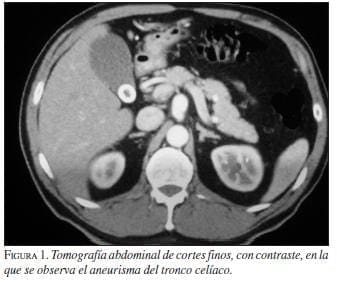 Tomografía Abdominal de Cortes Finos