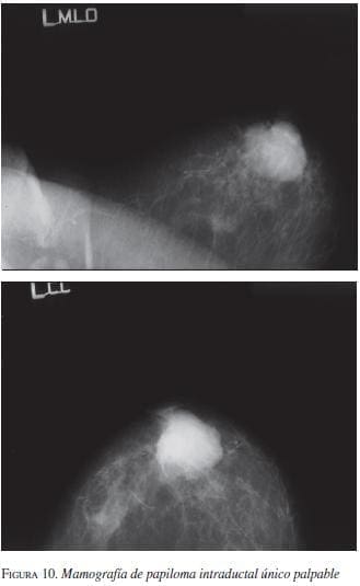 Mamografía de Papiloma Intraductal único Palpable Mamografía de Papiloma Intraductal único Palpable