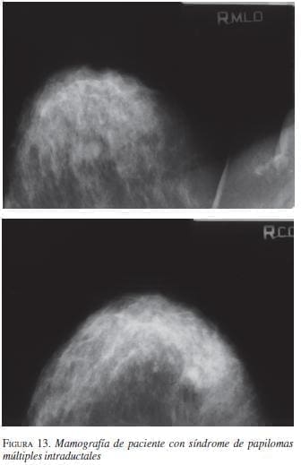 Mamografía de paciente con Síndrome de Papilomas Múltiples Intraductales Mamografía de paciente con Síndrome de Papilomas Múltiples Intraductales