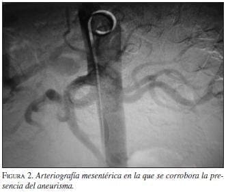 Arteriografía Mesentérica se corrobora presencia de Aneurisma Arteriografía Mesentérica se corrobora presencia de Aneurisma