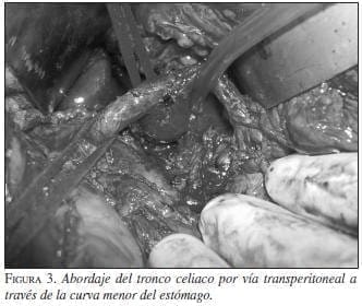 Abordaje del Tronco Celiaco por vía Transperitoneal Abordaje del Tronco Celiaco por vía Transperitoneal