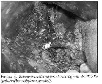 Reconstrucción Arterial con Injerto de PTFE Reconstrucción Arterial con Injerto de PTFE