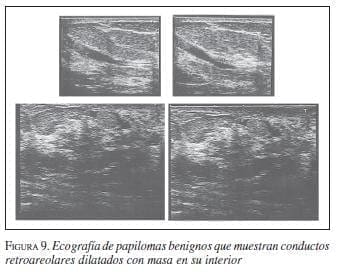 Ecografias de Papilomas Benignos Ecografias de Papilomas Benignos