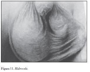 Hidrocele