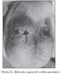 Hidrocele o Quiste del Cordón Espermático