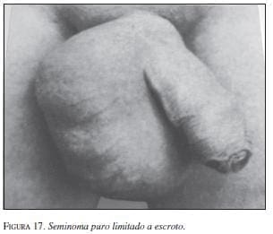 Seminoma puro Limitado a Escroto Seminoma puro Limitado a Escroto