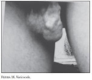varicocele varicocele