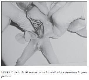 Feto de 20 Semanas con los Testículos entrando a la Zona Pélvica Feto de 20 Semanas con los Testículos entrando a la Zona Pélvica
