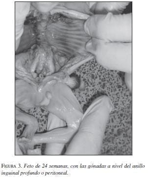 Feto de 24 Semanas con las Gónadas a nivel del Anillo Inguinal Feto de 24 Semanas con las Gónadas a nivel del Anillo Inguinal
