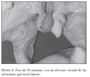 Feto de 36 Semanas con un Descenso Normal Feto de 36 Semanas con un Descenso Normal
