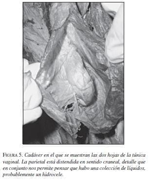Cadáver en el que se muestran las dos hojas de la Túnica Vaginal Cadáver en el que se muestran las dos hojas de la Túnica Vaginal