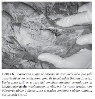 Cadáver donde se Observa un Saco Herniario Cadáver donde se Observa un Saco Herniario