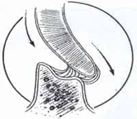 Cartílago septal a nivel de su inserción inferior Cartílago septal a nivel de su inserción inferior