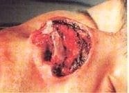 Reconstrucción de ala nasal Reconstrucción de ala nasal