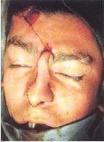 Cruenta frontal Cruenta frontal