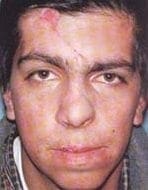 Control al mes de autonomizado el colgajo Control al mes de autonomizado el colgajo