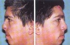 Control Neurotecoma celular atípico nasal Control Neurotecoma celular atípico nasal