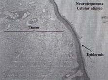 Tumor dérmico Tumor dérmico