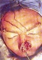 Diseño del colgajo frontal Diseño del colgajo frontal