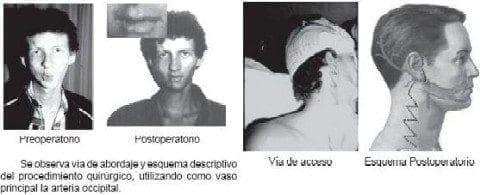 Colgajo muscular de esternocleidomastoideo