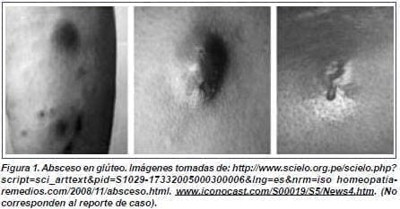 Absceso en Glúteo posterior a inyección intramuscular - caso clínico