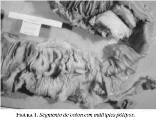 Segmento de Colon con Múltiples Pólipos Segmento de Colon con Múltiples Pólipos