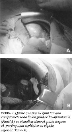 Quiste compromete toda la longitud de la Laparotomía