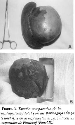 Tamaño Comparativo de la Esplenectomía-portaagujas total con un Portaagujas largo