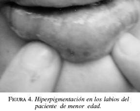 Hiperpigmentación en los Labios del Paciente de Menor de Edad Hiperpigmentación en los Labios del Paciente de Menor de Edad