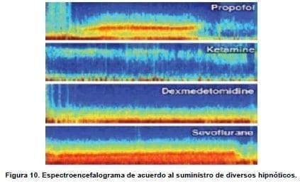 Espectroencefalograma de acuerdo al suministro de diversos hipnóticos Espectroencefalograma de acuerdo al suministro de diversos hipnóticos
