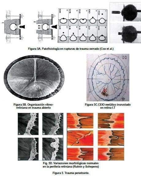 Trauma Ocular penetrante  Trauma Ocular penetrante